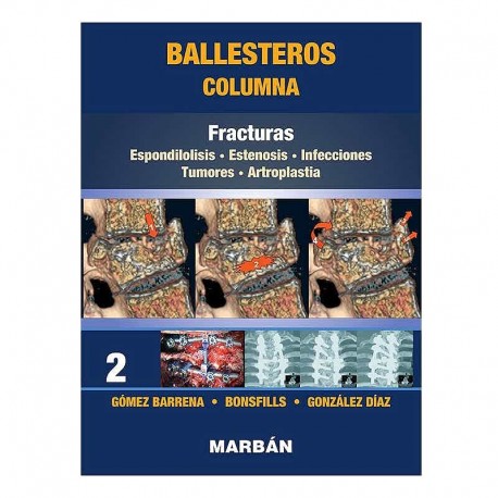 COLUMNA TOMO 2 FRACTURAS. ESPONDILOLISIS. ESTENOSIS. INFECCIONES. TUMORES. ARTROPLASTIA