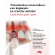 TRATAMIENTOS RESTAURADORES CON IMPLANTES EN EL SECTOR ANTERIOR. CASOS CLINICOS PASO A PASO