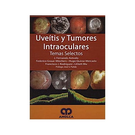 UVEITIS Y TUMORES INTRAOCULARES