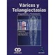VARICES Y TELANGIECTASIAS. DIAGNOSTICO Y TRATAMIENTO