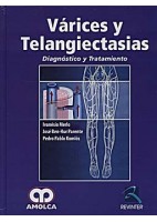 VARICES Y TELANGIECTASIAS. DIAGNOSTICO Y TRATAMIENTO