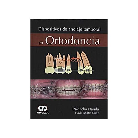 DISPOSITIVOS DE ANCLAJE TEMPORAL EN ORTODONCIA