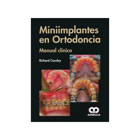 MINIIMPLANTES EN ORTODONCIA. MANUAL CLINICO