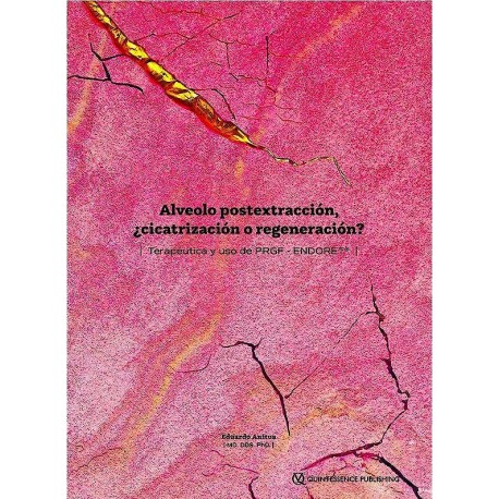 ALVEOLO POSTEXTRACCION. CICATRIZACION O REGENERACION. TERAPEUTICA Y USO DE PRGF - ENDORET