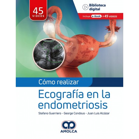 COMO REALIZAR ECOGRAFIA EN LA ENDOMETRIOSIS