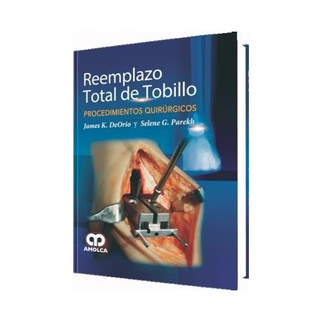 REEMPLAZO TOTAL DE TOBILLO