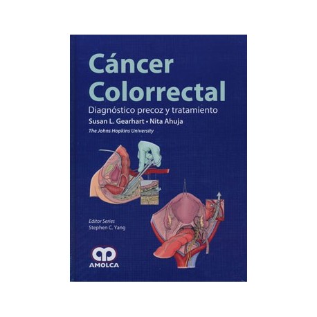 CANCER COLORRECTAL. DIAGNOSTICO PRECOZ Y TRATAMIENTO