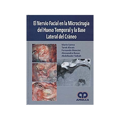 EL NERVIO FACIAL EN LA MICROCIRUGIA DEL HUESO TEMPORAL Y LA BASE LATERAL DEL CRANEO
