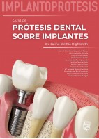 IMPLANTOPROTESIS. GUIA DE PROTESIS DENTAL SOBRE IMPLANTES