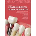 IMPLANTOPROTESIS. GUIA DE PROTESIS DENTAL SOBRE IMPLANTES