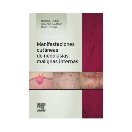 MANIFESTACIONES CUTANEAS DE NEOPLASIAS MALIGNAS INTERNAS