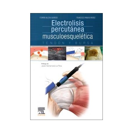 ELECTROLISIS PERCUTANEA MUSCULOESQUELETICA. TENDON Y BURSA
