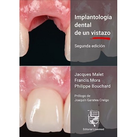 IMPLANTOLOGIA DENTAL DE UN VISTAZO