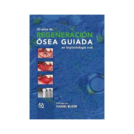 20 AÑOS DE REGENERACION OSEA GUIADA EN IMPLANTOLOGIA ORAL