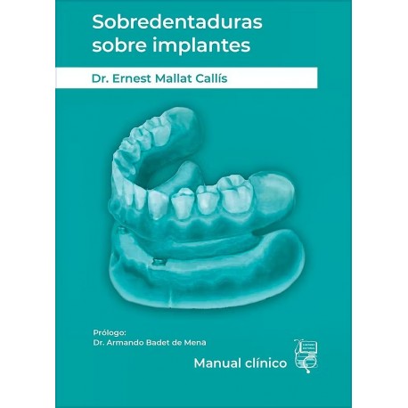 SOBREDENTADURAS SOBRE IMPLANTES. MANUAL CLINICO