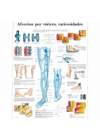 AFECCION POR VARICES (VR-3367)
