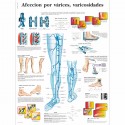 AFECCION POR VARICES (VR-3367)