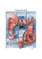 CANCER DE COLON (VR-3432)