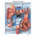 CANCER DE COLON (VR-3432)