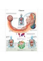 CANCER (VR-3753)