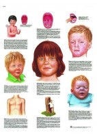 ENFERMEDADES DE LA INFANCIA (VR-3741)