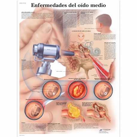 ENFERMEDADES DEL OIDO MEDIO (VR-3252)