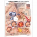 ENFERMEDADES DEL OIDO MEDIO (VR-3252)