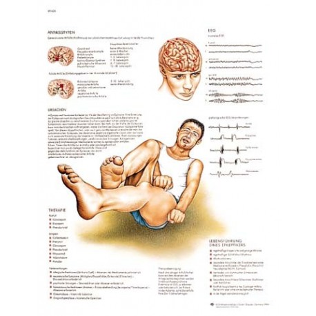 EPILEPSIA (VR-3626)