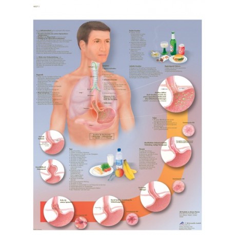 ESOFAGITIS POR REFLUJO (VR-3711)