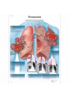 NEUMONIA (VR-3326)