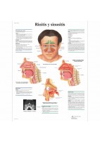 RINITIS Y SINUSITIS (VR-3251)