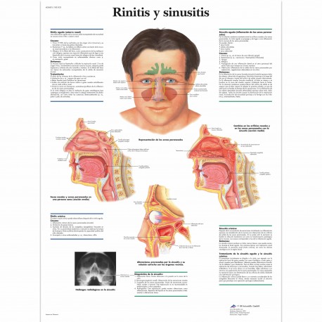 RINITIS Y SINUSITIS (VR-3251)