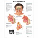 RINITIS Y SINUSITIS (VR-3251)