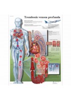 TROMBOSIS VENOSA PROFUNDA (VR-3368)