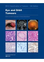 WHO CLASSIFICATION OF TUMOURS: EYE AND ORBIT TUMOURS