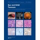 WHO CLASSIFICATION OF TUMOURS: EYE AND ORBIT TUMOURS