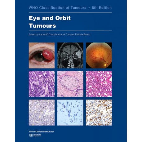 WHO CLASSIFICATION OF TUMOURS: EYE AND ORBIT TUMOURS