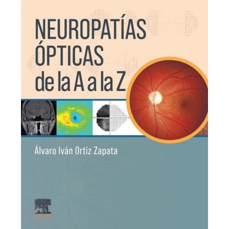 NEUROPATIAS OPTICAS DE LA A A LA Z