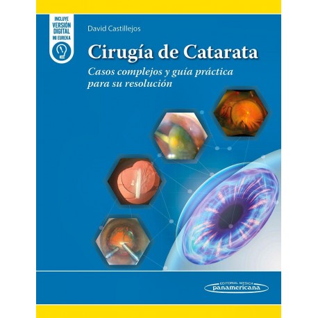 CIRUGIA DE CATARATA. CASOS COMPLEJOS Y GUIA PRACTICA PARA SU RESOLUCION
