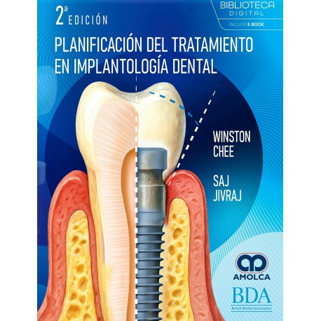 PLANIFICACION DEL TRATAMIENTO EN IMPLANTOLOGIA DENTAL