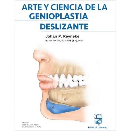 ARTE Y CIENCIA DE LA GENIOPLASTIA DESLIZANTE