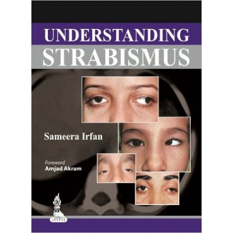 UNDERSTANDING STRABISMUS