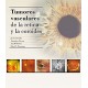 TUMORES VASCULARES DE LA RETINA Y DE LA COROIDES