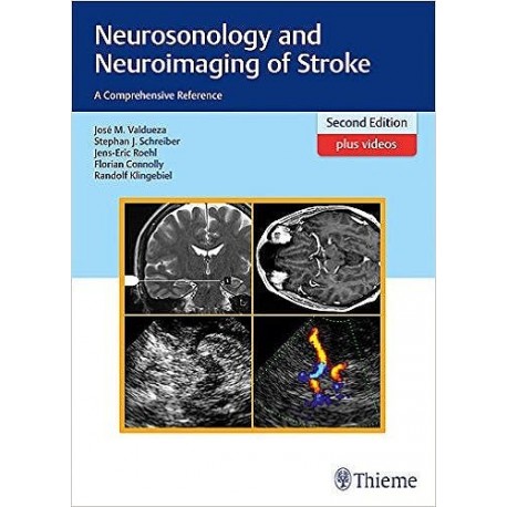 NEUROSONOLOGY AND NEUROIMAGING OF STROKE + VIDEOS