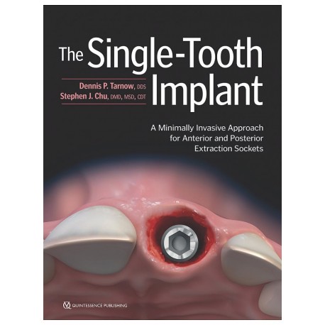 THE SINGLE-TOOTH IMPLANT